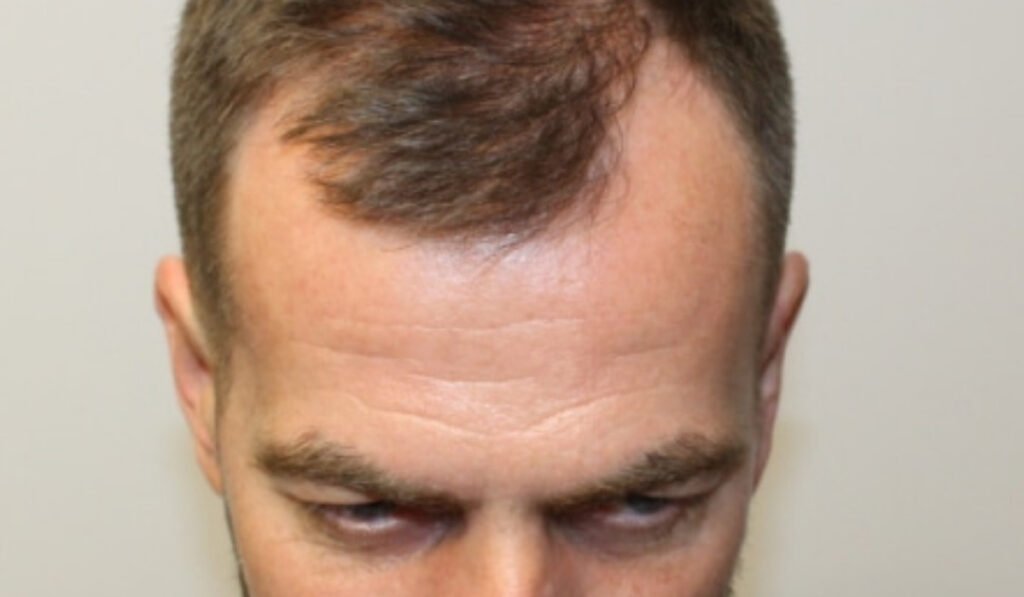 best hair transplant uk