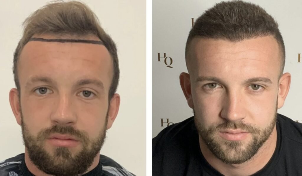 best hair transplant uk