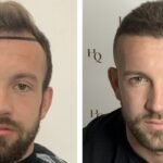 best hair transplant uk