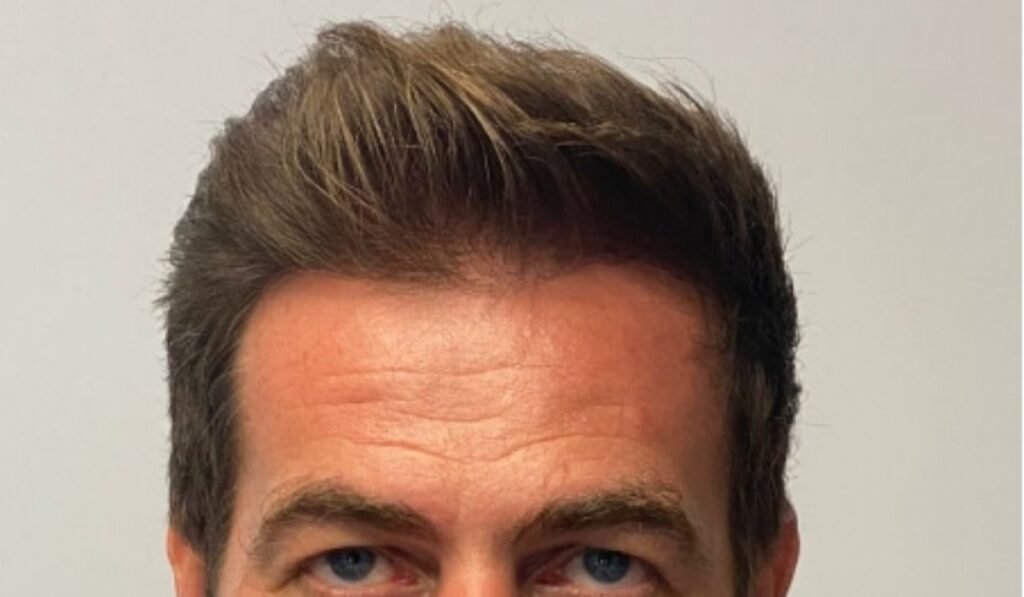 best hair transplant uk