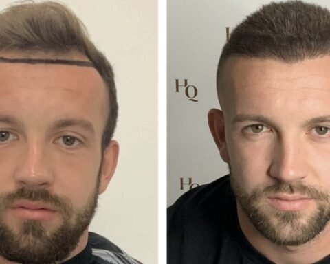 best hair transplant uk