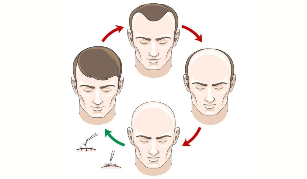 Spain’s Hair Transplant