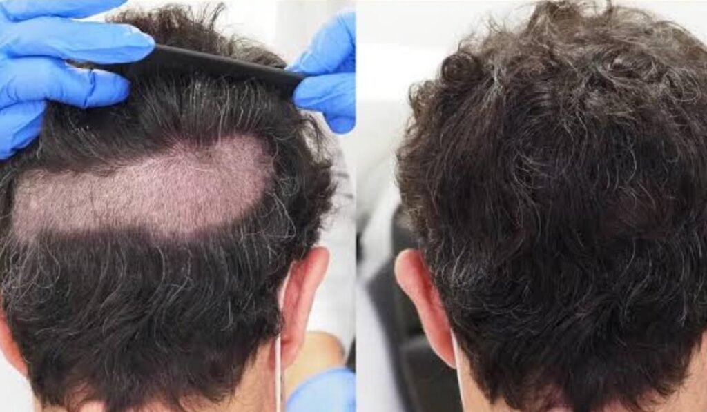 Spain’s Hair Transplant