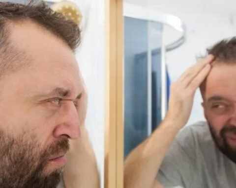 Spain’s Hair Transplant